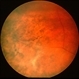 CMV Retinitis Granular Type